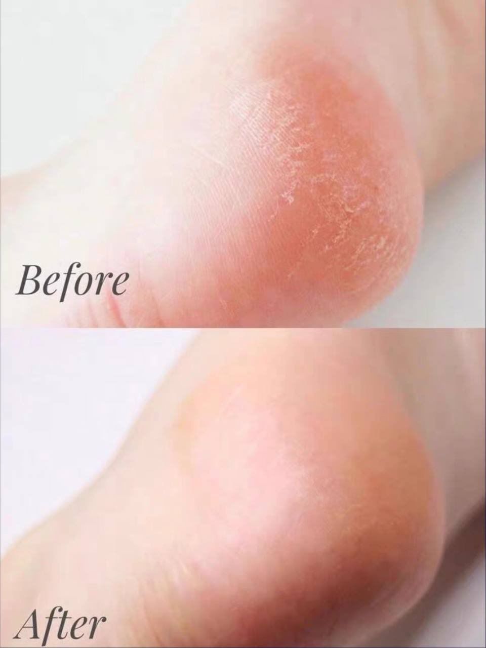 MEDIPEEL EGF 足部修护霜 130g 2